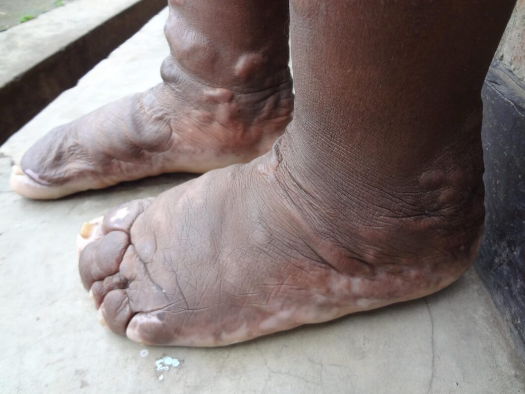 zwei Füße welche von Podokoniose betroffen sind und stark geschwollen sind